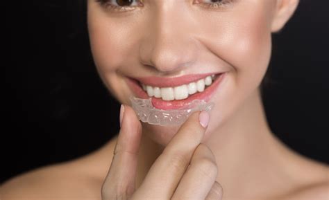 Magical tooth aligner for an immediate and radiant smile enhancement